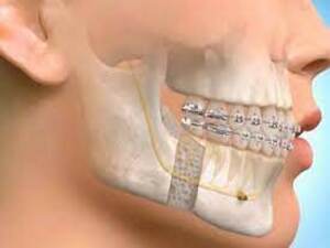 Maxillofacial Surgery KNOW MORE